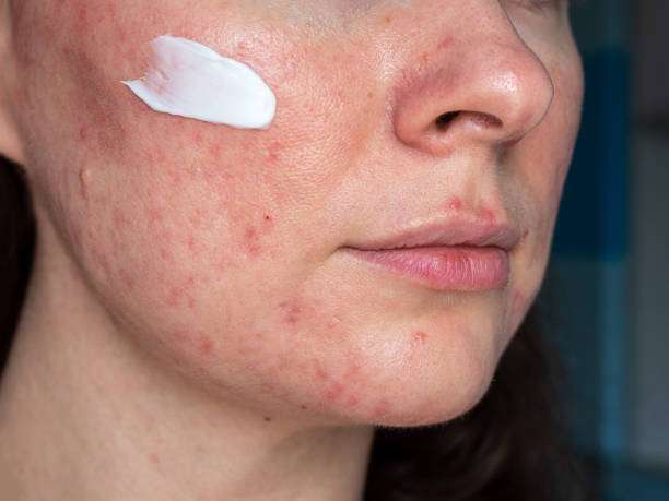 Rosacea Treatment